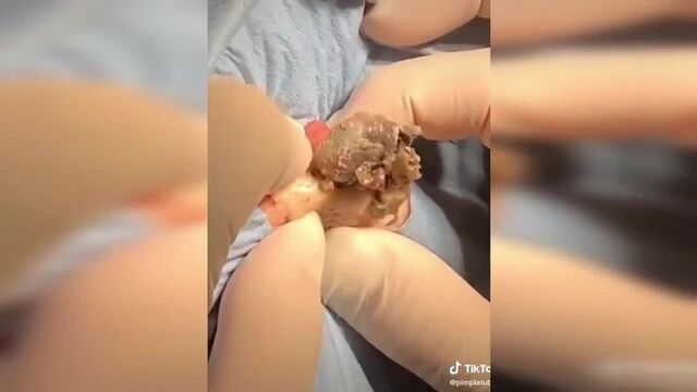 Подборка выдавливания прыщей I выдавливание прыща